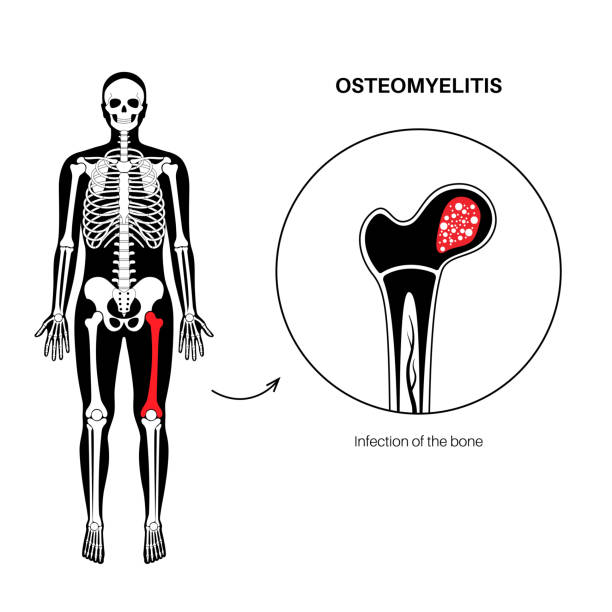femoral osteomyelitis
