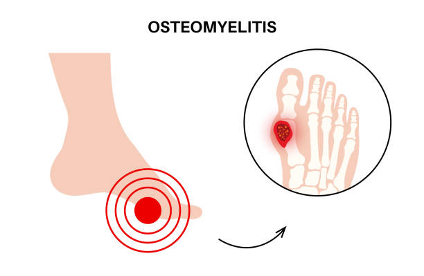 osteomyelitis on the toe