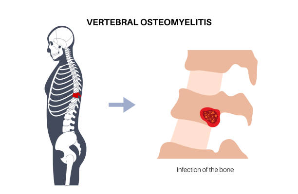 vertebrae osteomyelitis