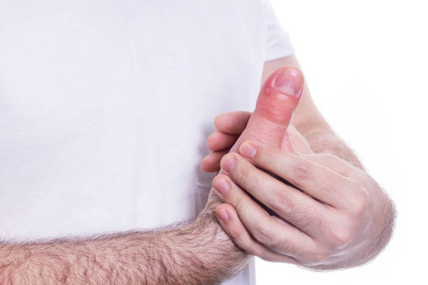 thumb arthritis
